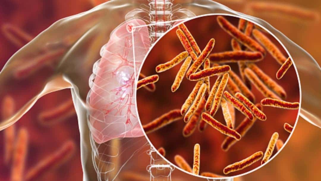 Tuberculosis moldeo el sistema inmunologico humano segun ADN antiguo Pixabay 