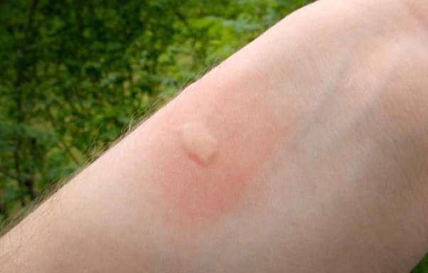 mosquito bite on arm2
