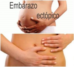 síntomas del embarazo ectópico 665x285